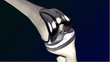 insert mako knee Summit Surgery Center